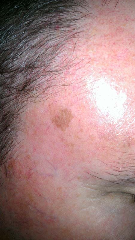 Irregular Skin Before and After – Celebrity Skin Studio